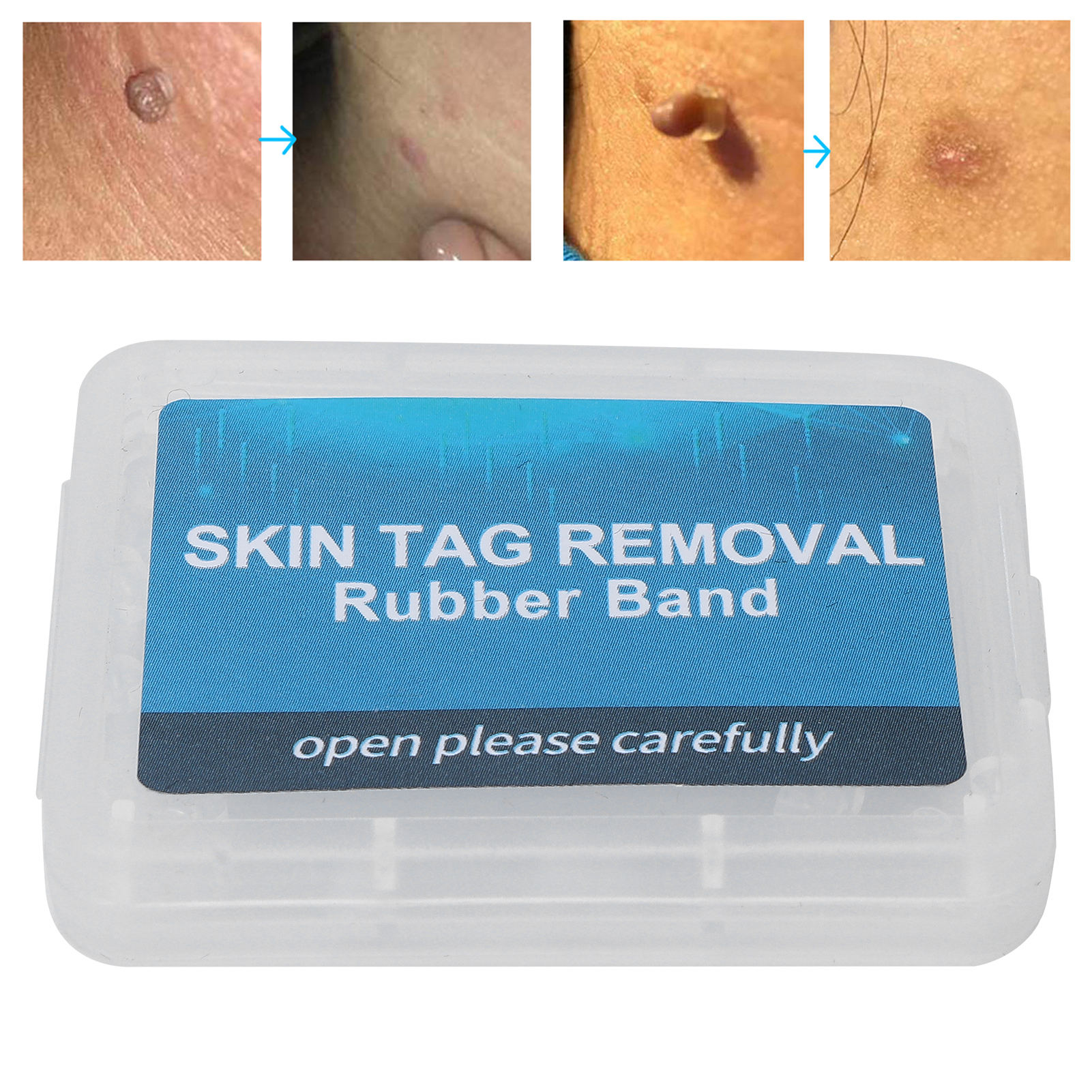 Skincare Ingredients Checker - 30Pcs Painless Skin Tag Removal Kit