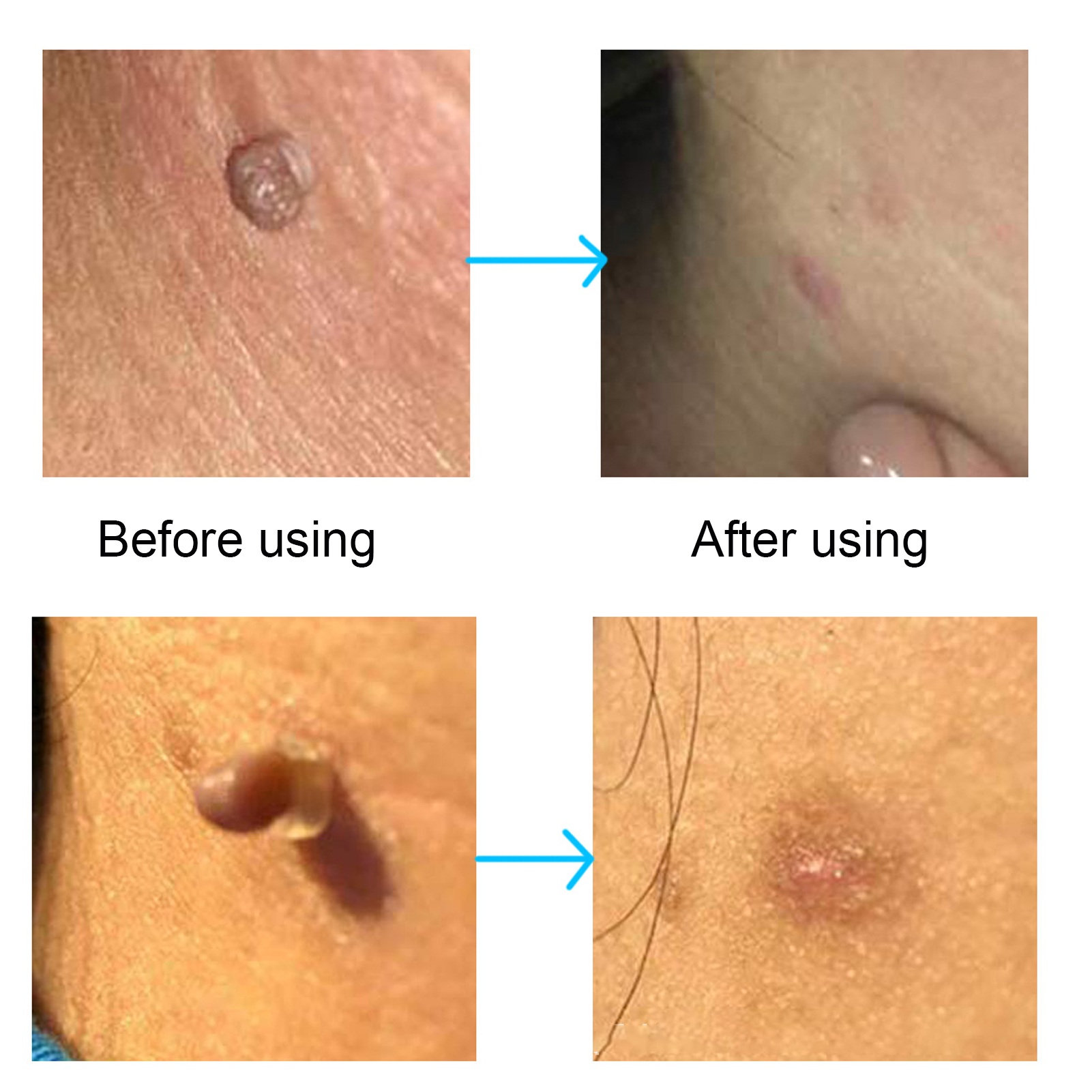 30Pcs Painless Skin Tag Remova - مراجعة Skincare Ingredients Checker وسعره